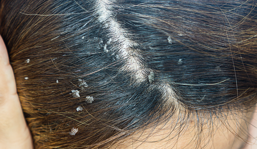 Our Experts Explain How to Wash Hair With Scalp Psoriasis