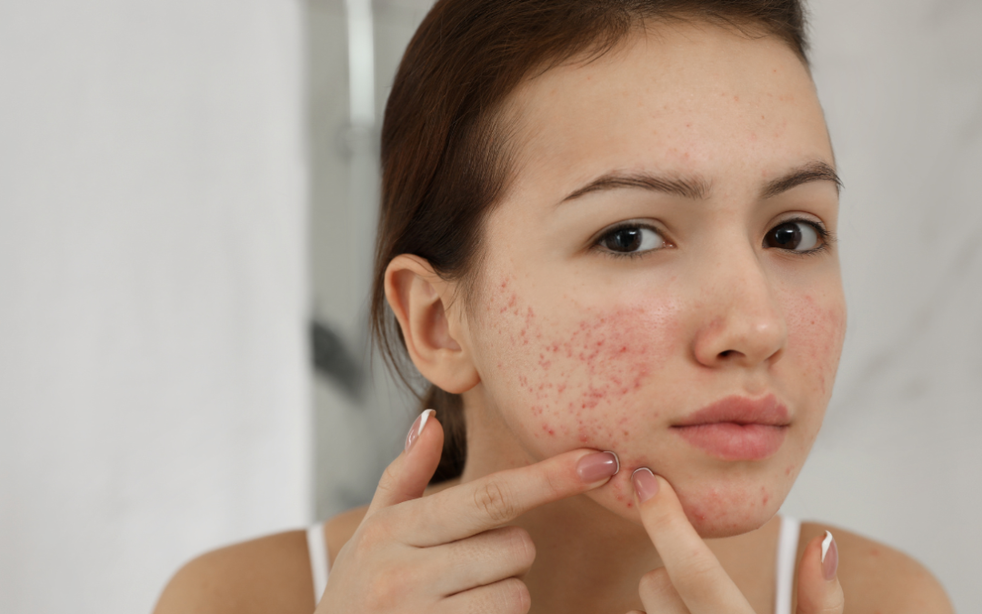 Acne Breakouts: Effective Strategies for Acne Spot Treatment